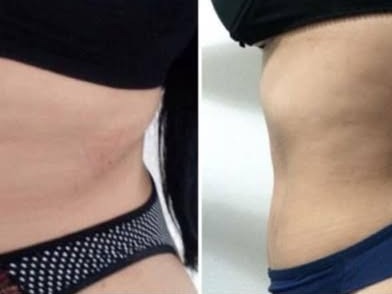 Antes e depois do contorno corporal, publicado pela Cristal Estética para seu protocolo de redução de medidas