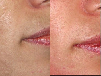 Referência externa: cicatrizes de acne antes e depois do microagulhamento, estudo de Imran Majid; não é um caso da Cristal